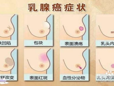 从摸到疙瘩到确诊：乳腺癌的发现与应对之路
